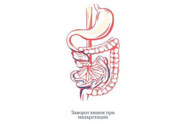 Кто виноват в завороте кишок? Кто виноват в завороте кишок?