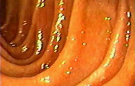 Дуоденоскопия: рельеф слизистой в нисходящей части двенадцатиперстной кишки. фото 1.