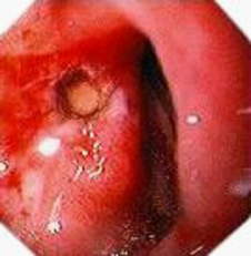 Дуоденоскопия: диффузное кровотечение из зоны перифокального воспаления при дуоденальной язве.