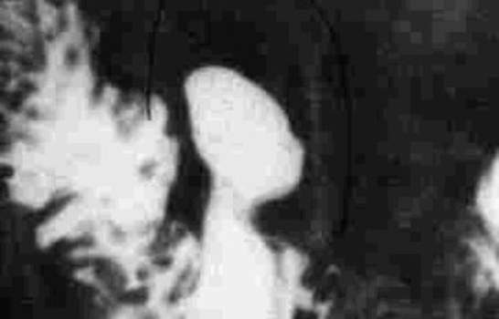 Рентгеноскопия: по медиальной стенке нисходящей части двенадцатиперстной кишки определяется дивертикул размером 2 на 4 см с ровными стенками и узким устьем.