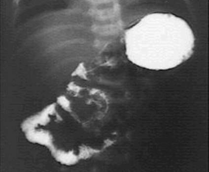 Рентгеноскопия: сужение постбульбарного отдела двенадцатиперстной кишки.