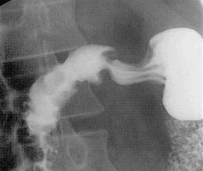 Рентгенография: полип двенадцатиперстной кишки, проявляющийся дефектом наполнения округлой формы с четкими, несколько бугристыми контурами. фото 1.