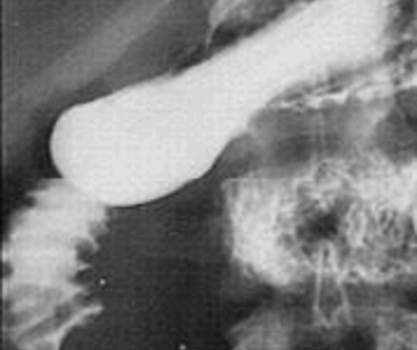 Рентгенография: полип двенадцатиперстной кишки, проявляющийся дефектом наполнения округлой формы с четкими, несколько бугристыми контурами. фото 3.