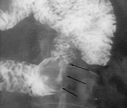 Рентгенография: лейомиома двенадцатиперстной кишки. фото 1.
