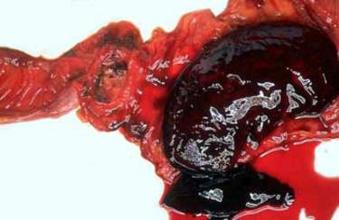 Тромботические массы, образовавшиеся в результате массивного кровотечения из язвы двенадцатиперстной кишки (макропрепарат).