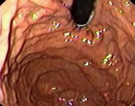 Гастроскопия дна желудка: характерный вид складок слизистой оболочки