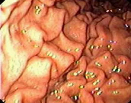 Гастроскопия тела желудка: вид складок слизистой оболочки по большой кривизне. фото 1.
