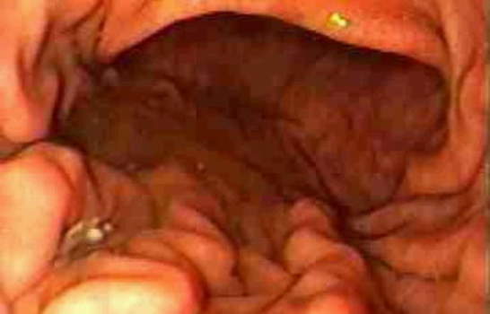 Гастроскопия тела желудка: вид складок слизистой оболочки по большой кривизне. фото 2.