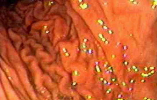Гастроскопия тела желудка: вид складок слизистой оболочки по большой кривизне. фото 3.