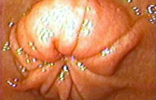 Гастроскопия: привратник в виде точечного отверстия. фото 2.
