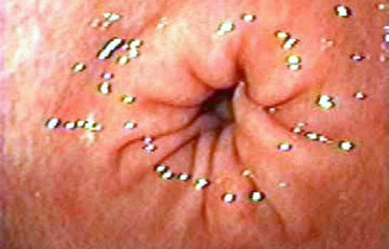 Гастроскопия: складки слизистой оболочки привратниковой части желудка. фото 1.