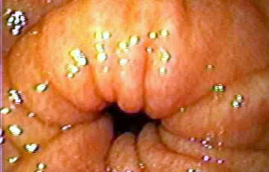 Гастроскопия: складки слизистой оболочки привратниковой части желудка. фото 2.