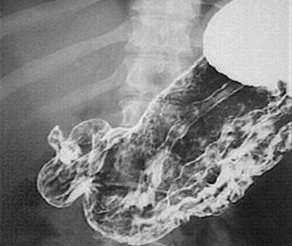 Рентгенография желудка (двойное контрастирование): характерные проявления острого гастрита  - утолщение складок, ухудшение импрегнации контрастом