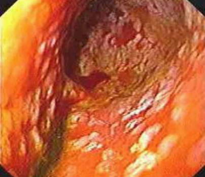 Гастроскопия: участки кишечной метаплазии в антральном отделе желудка. фото 2.