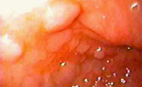 Гастроскопия: участки кишечной метаплазии в антральном отделе желудка. фото 3.
