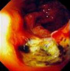 Гастроскопия: язва проксимального отдела желудка у больного сифилисом.