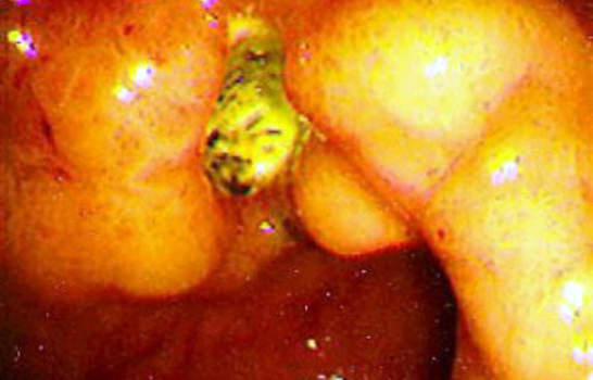 Гастроскопия: гиперемия и отек слизистой вокруг язвенного дефекта желудка.