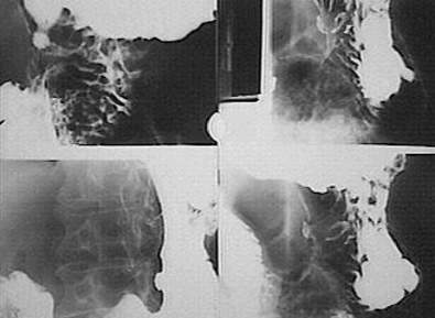 Рентгенография при двойном контрастировании желудка: язвенный дефект диаметром 10 мм,  расположенный по малой кривизне. Признаки малигнизации  отсутствуют.