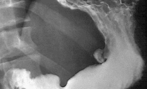 Рентгенография при двойном контрастировании желудка: определяется выраженная конвергенция складок слизистой оболочки.