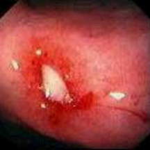 Гастроскопия: кровотечение из краев язвы желудка. фото 1.