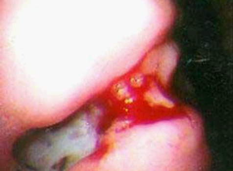 Гастроскопия: кровотечение из краев язвы желудка. фото 2.