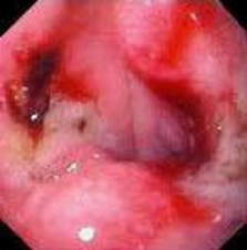 Гастроскопия: язва желудка с видимыми сосудами и следами завершившегося кровотечения.