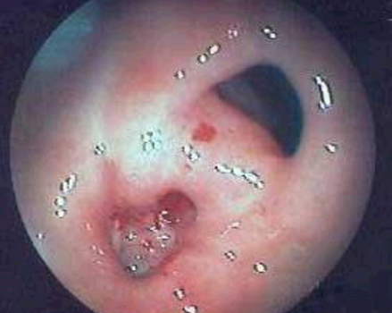 Гастроскопия: препилорическая язва на задней стенке антрального отдела с видимым отверстием.