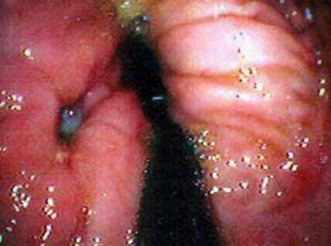 Гастроскопия: язва желудка, глубоко пенетрирующая в его стенку. фото 1.