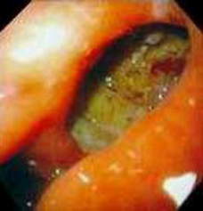 Гастроскопия: язва желудка, глубоко пенетрирующая в его стенку. фото 2.