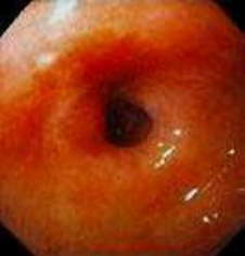 Гастроскопия: вид стенозированного привратника желудка у больного с длительно текущей язвенной болезнью.