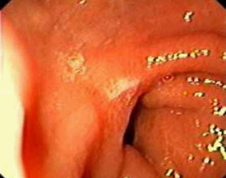 Гастроскопия: деформация и сужение пилорического отдела желудка при язвенной болезни. фото 2.