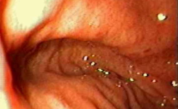 Гастроскопия: дивертикул желудка грушевидной формы.