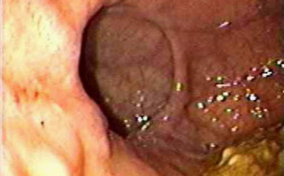 Гастроскопия: дивертикул желудка овальной формы.