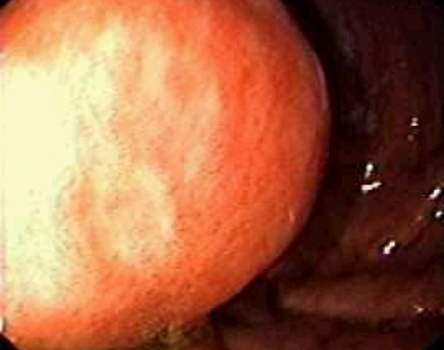 Гастроскопия: лейомиома по большой кривизне желудка. фото 1.