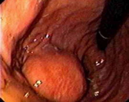 Гастроскопия: лейомиома по большой кривизне желудка. фото 2.