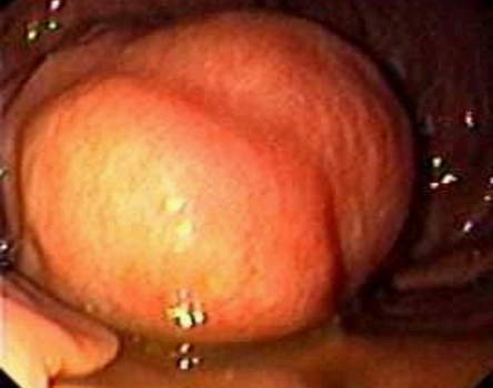 Гастроскопия: крупная лейомиома желудка.