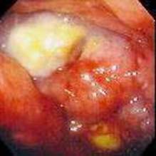 Гастроскопия: большая лимфома желудка с признаками распада. фото 1.