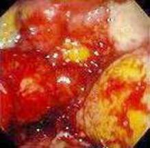 Гастроскопия: большая лимфома желудка с признаками распада. фото 2.