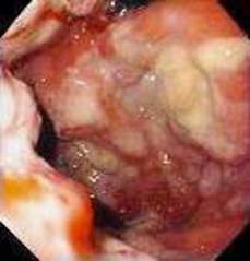 Гастроскопия: распространенное образование желудка с признаками изъязвления – метастаз лимфомы в желудок. фото 2.