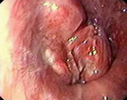 Гастроскопия: рак кардиального отдела желудка с переходом на пищевод. В области кардии имеется бугристая плотная опухоль. фото 1.