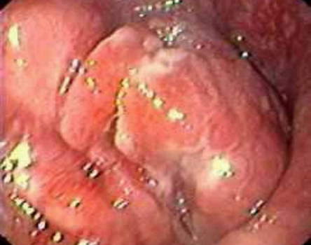 Гастроскопия: рак кардиального отдела желудка с переходом на пищевод. В области кардии имеется бугристая плотная опухоль. фото 2.