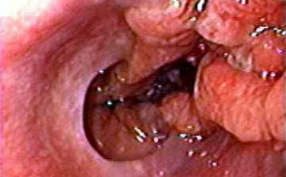 Гастроскопия: рак кардиального отдела желудка с переходом на пищевод. фото 2.