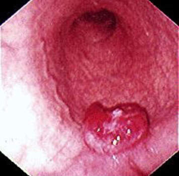 Гастроскопия: бляшковидный рак желудка – по большой кривизне на границе средней трети и антрального отдела.