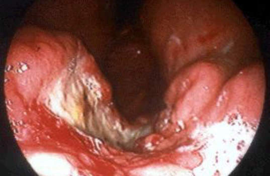 Гастроскопия: распространенный рак желудка с изъязвлением и кровотечением.
