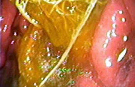Гастроскопия: фитобезоар в просвете желудка. фото 1.