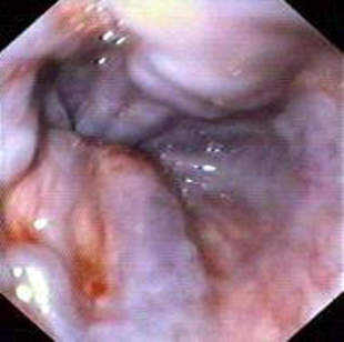 Гастроскопия: расширенные вены слизистой оболочки нижней трети пищевода и кардиального отдела желудка. фото 1.