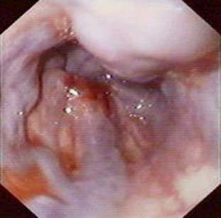 Гастроскопия: расширенные вены слизистой оболочки нижней трети пищевода и кардиального отдела желудка. фото 2.