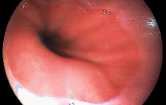 Гастроскопия: грыжа хиатуса. Хорошо видна разделительная линия между слизистой пищевода и желудка.
