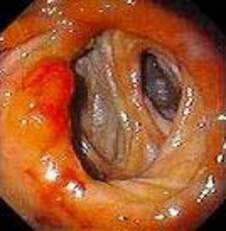 Гастроскопия: гастроэнтероанастомоз после резекции желудка по поводу язвенной болезни. Справа приводящая петля тощей кишки,  слева - отводящая. фото 1.