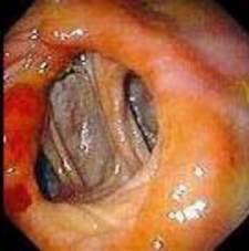 Гастроскопия: гастроэнтероанастомоз после резекции желудка по поводу язвенной болезни. Справа приводящая петля тощей кишки,  слева - отводящая. фото 2.